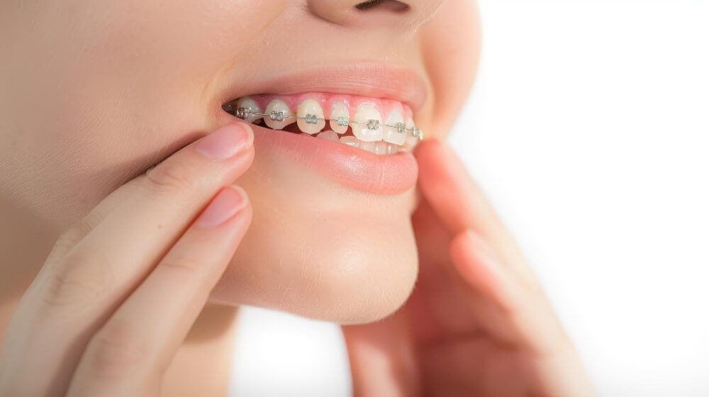 Vệ sinh răng miệng khi niềng